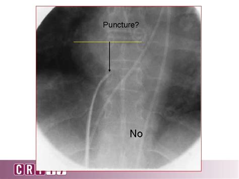 How To Perform A Successful Transseptal Puncture Zoltan