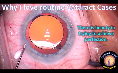 Why I Love Routine Cataract Cases Cataract Coach™