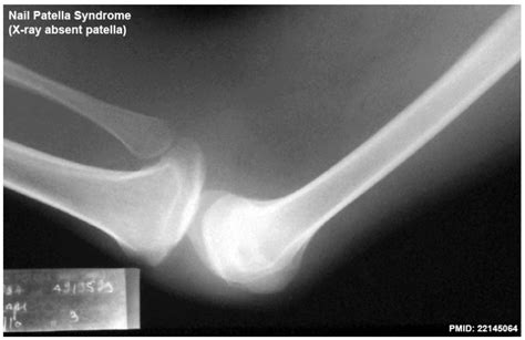 Filenail Patella Syndrome 02 Embryology