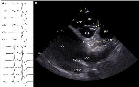 Successful Ablation Of Idiopathic Pvcs Originating From The Commissure