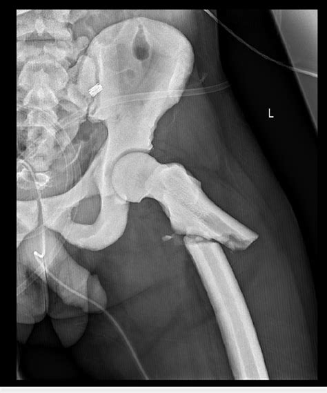 Left femur fracture. | Download Scientific Diagram