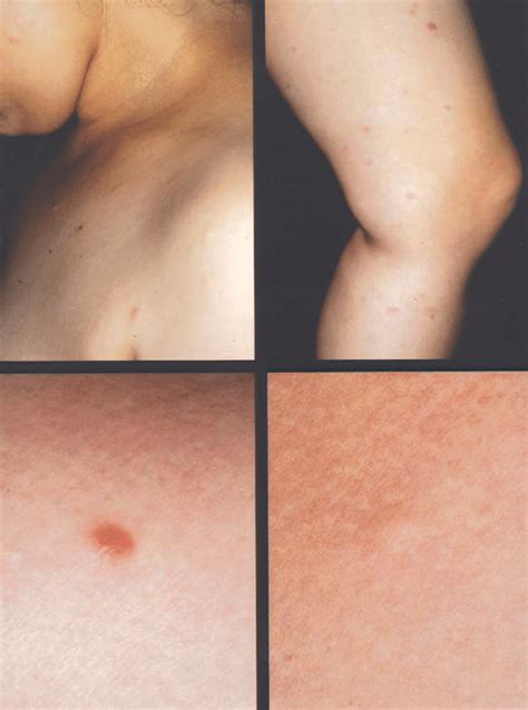 Generalized Asymptomatic Flesh Yellow To Reddish Brown Papules And Download Scientific Diagram