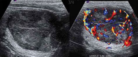 abnormal thyroid cancer ultrasound colors - Katelynn Deluca