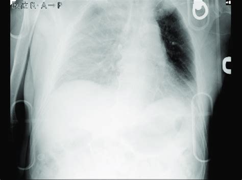 Chest X-ray on arrival The X-ray suggested right hemothorax. | Download ...