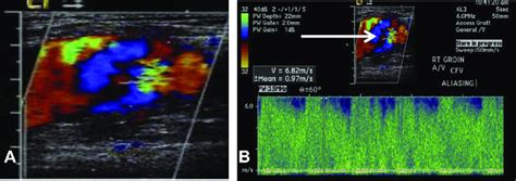 A Enhanced Color Doppler Of The Right Groin B Aliasing Flow Pattern Download Scientific