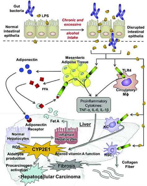 Alcoholic Liver Disease Pathophysiology