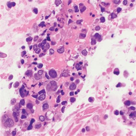 Biopsy showing (A) squamous mucosa with acute inflammation and reactive ...