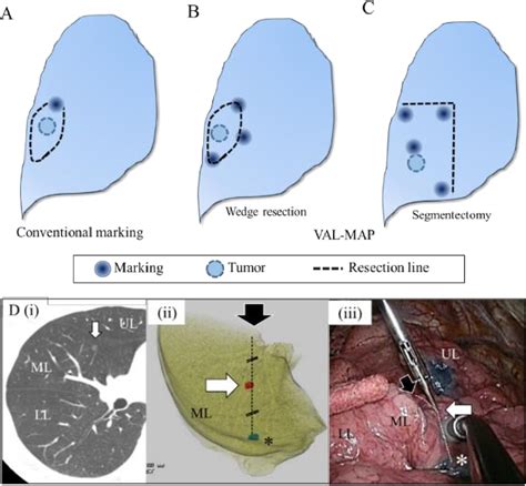 Figure 1 From Virtual Assisted Lung Mapping Navigational Thoracoscopic