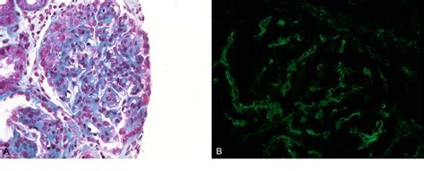 Figure 1 From A Case Series Of Diffuse Crescentic Iga Nephropathy An Omitted Entity In The