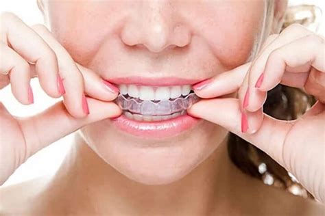 Qu Son Los Ataches En Invisalign Y Para Qu Sirven Ferrus Bratos