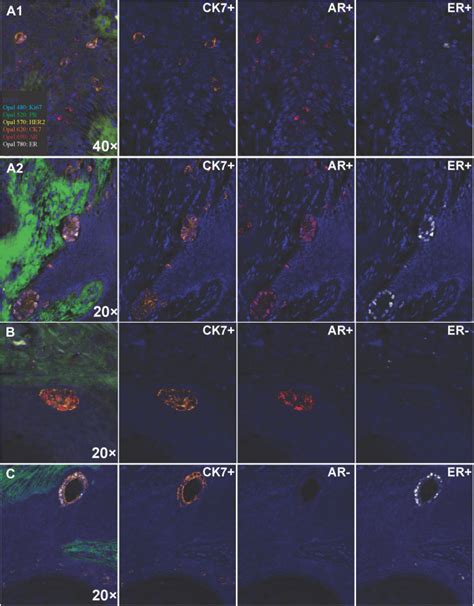 Toker Cell Hyperplasia In The Nipple Areolar Complex Of Transmasculine