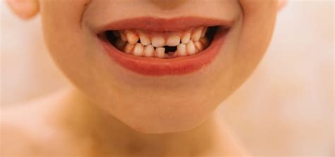 O Sorriso De Uma Criança Que Perdeu Um Dente De Leite Cuidar Dos