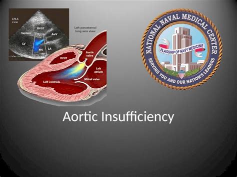 (PPT) Aortic Insufficiency. Outline Epidemiology Etiology ...