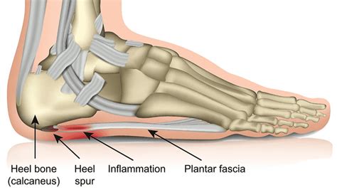 Plantar Fasciitis Treatment The Ultimate Guide Modpod Podiatry