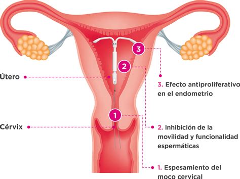 Alguna Vez Te Has Puesto Un DIU Hormonal O Conoces A Alguien Que Se