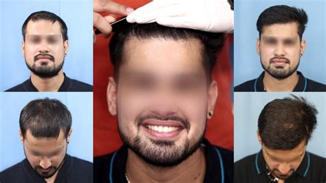 6 Months Update Of Hair Transplant 2574 Grafts Diffuse Pattern Regrow Clinic Youtube