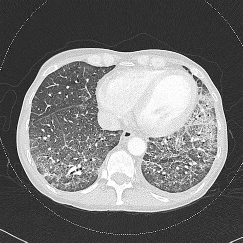 Hiv Related Pneumocystis Jirovecii Pneumonia Managed With Caspofungin And Veno Venous