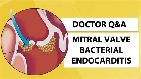 Mitral Valve Bacterial Endocarditis What Should Patients Know Youtube