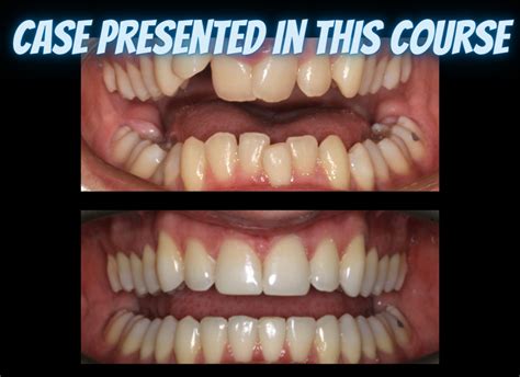 Class Ii Treatments With Clear Aligners The Clear Institute