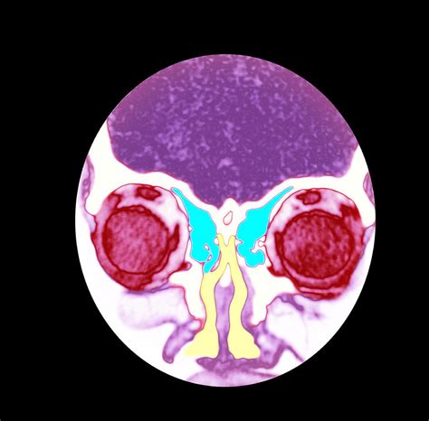 Nose And Sinuses, Ct Scan Photograph by