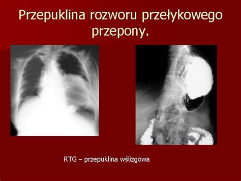 Diagnostyka Przewodu Pokarmowego Grny Odcinek Przewodu Pokarmowego Metody