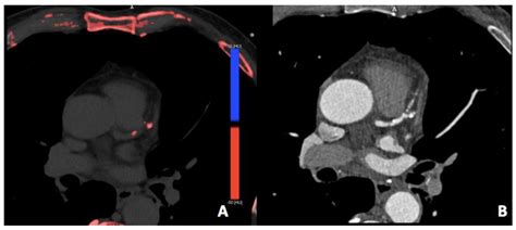 J Imaging Free Full Text Dual Energy Ct Of The Heart A Review