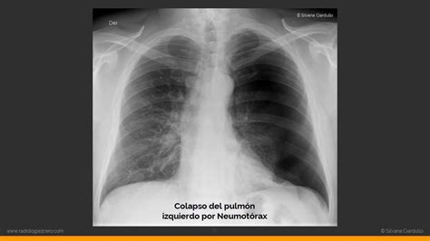 Patrones Pulmonares En La Radiograf A De T Rax Youtube