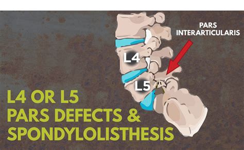 Have A Pars Defect at L4-L5? It Might Be Spondylolisthesis