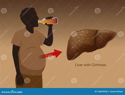 Liver With Cirrhosis Inside Human Body Royalty Free Illustration