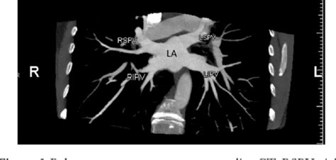 Pulmonary Vascular Anatomy And Anatomical Variants Semantic Scholar