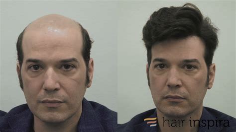 Aplicación prótesis capilar indetectable Hair Replacement fitting