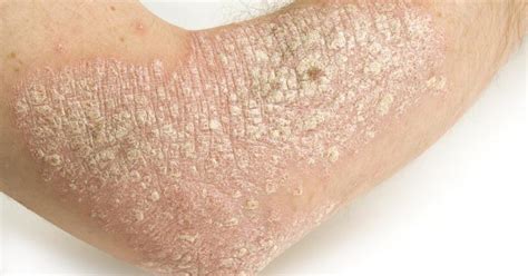 salep eksim kering  basah  bagus  ampuh obat