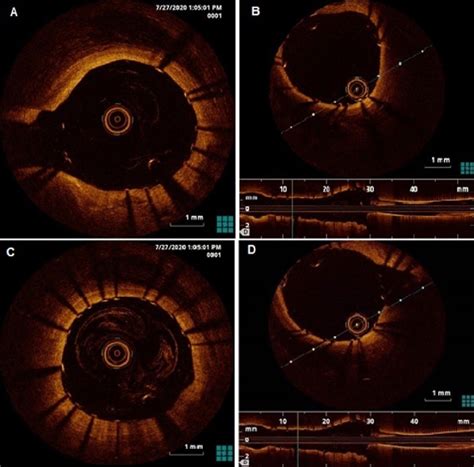 A-OCT of distal part of LM/LAD stent in proximal part of LAD; B-OCT of... | Download Scientific ...