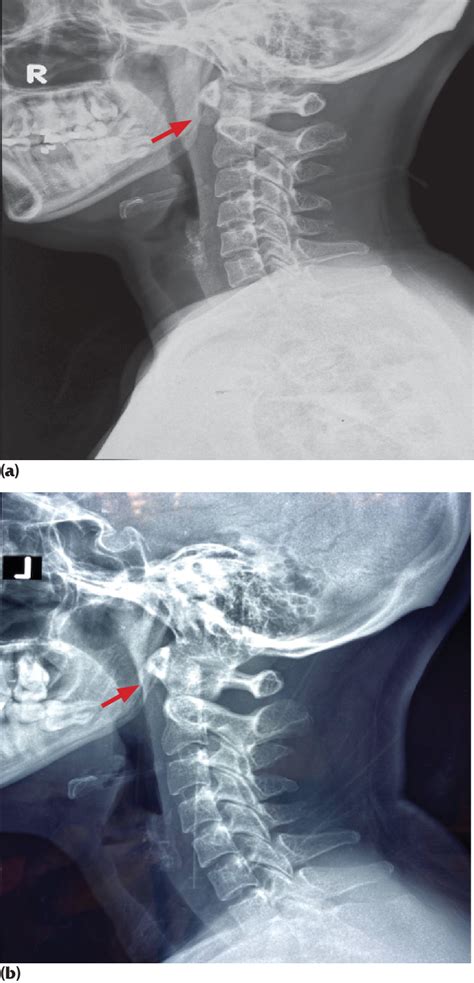 Figure 1 From Acute Retropharyngeal Calcific Tendonitis As A Rare Cause