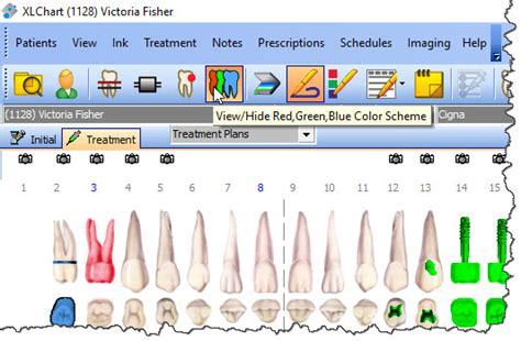 Xldent Red Green Blue Colors On Tooth Chart