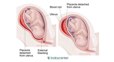 What Is A Placental Abruption Babycenter