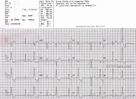 Sinus Rhythm With Ventricular Bigeminy | ECG Guru - Instructor Resources