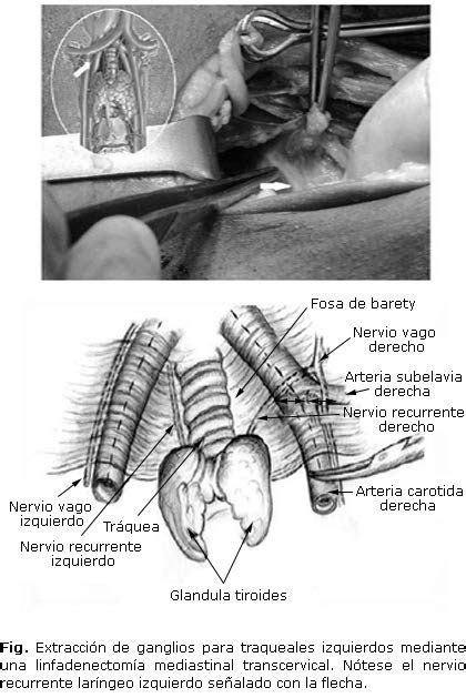 Linfadenectomía Transcervical Diagnóstico Terapéutica En El Carcinoma