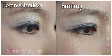 Review: Erase Under-eye Wrinkles with Botox » myBeautyCravings