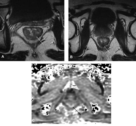 A 43 Year Old Male Patient Of Moderately Differentiated Rectal