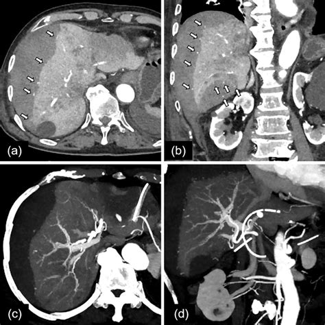 Figure1 Contrast Enhanced Computed Tomography Ct At The Onset Of Download Scientific Diagram