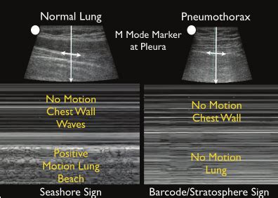 Picture Of Pneumothorax M Mode Ultrasound