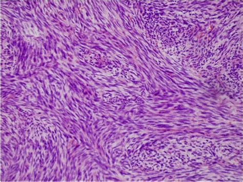 Synovial Sarcoma Histology