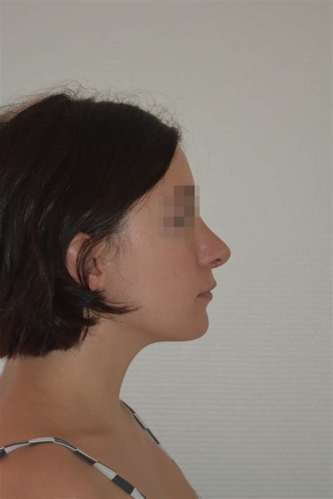 Rhinoplastie Secondaire avant après dr martin rhinoplastie