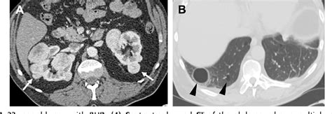 Table 1 From Imaging And Screening Of Hereditary Cancer Syndromes