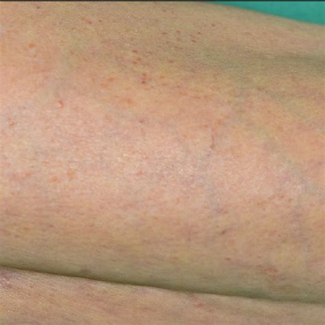 Skin Examination Polymorphic Pruritic Rash With Macular Vesicles