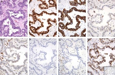 Clear cell carcinoma. A, Clear cell carcinoma of uterus demonstrates ...