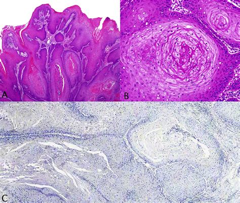 Pathology Of Invasive And Intraepithelial Penile Neoplasia European Urology Focus