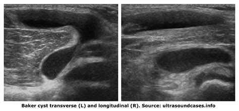 Get 40: Ruptured Baker's Cyst Ultrasound Appearance