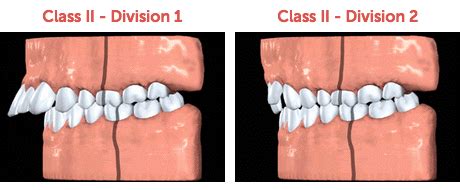 Class Ii Malocclusion Division Milagro Byrnes